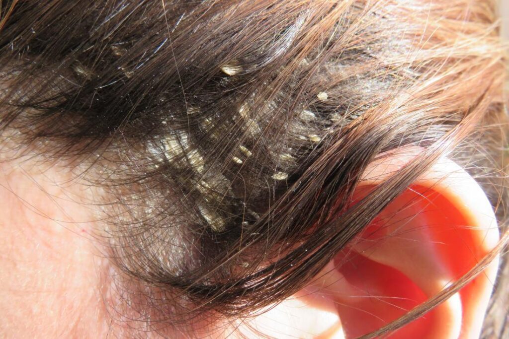 Cómo eliminar eficazmente las liendres pegadas al cabello 9 cuero cabelludo