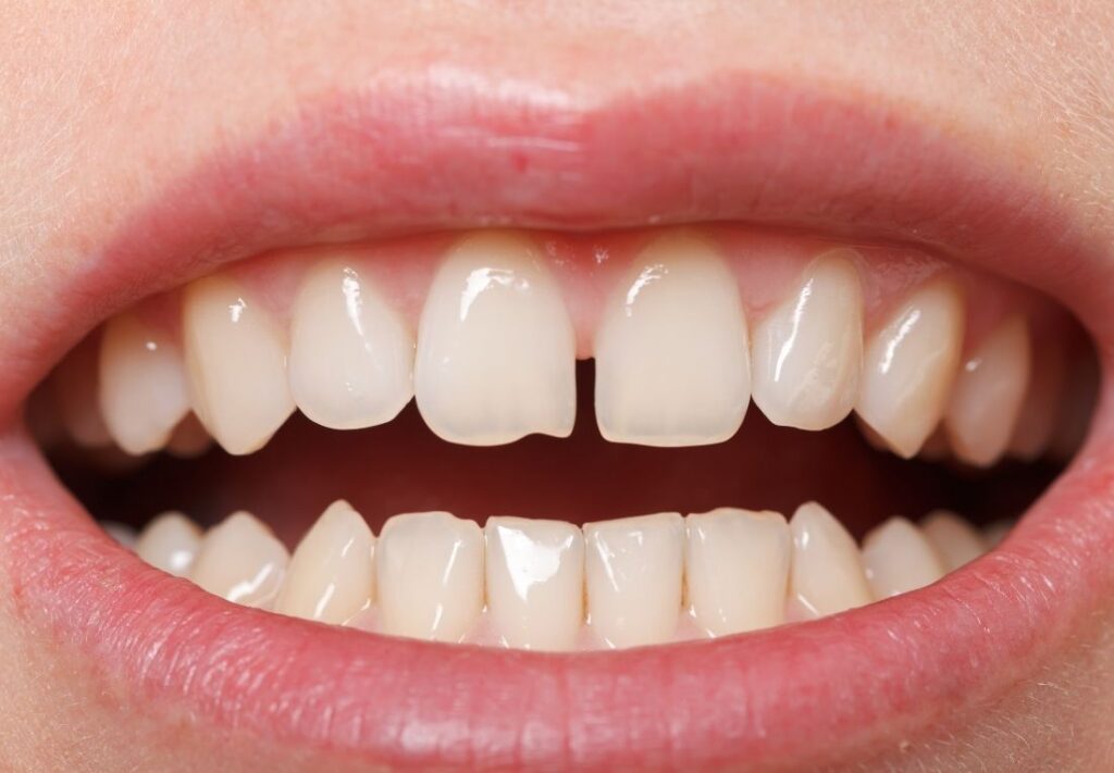 Qué significa soñar con alguien sin dientes delanteros 14 dientes delanteros