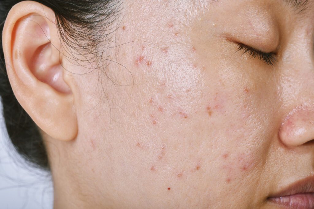 Cómo eliminar marcas de acné después de explotar granos 14 marcas acne